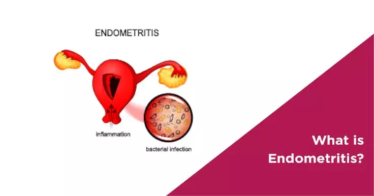 Endometritis
