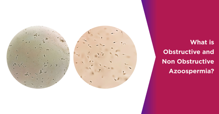  Obstructive vs. Non-Obstructive Azoospermia: What’s the Difference?