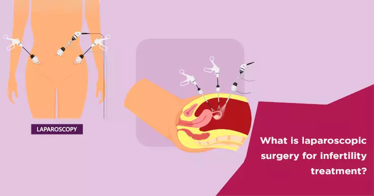  Laparoscopic Surgery for Infertility Treatment: How It Works?