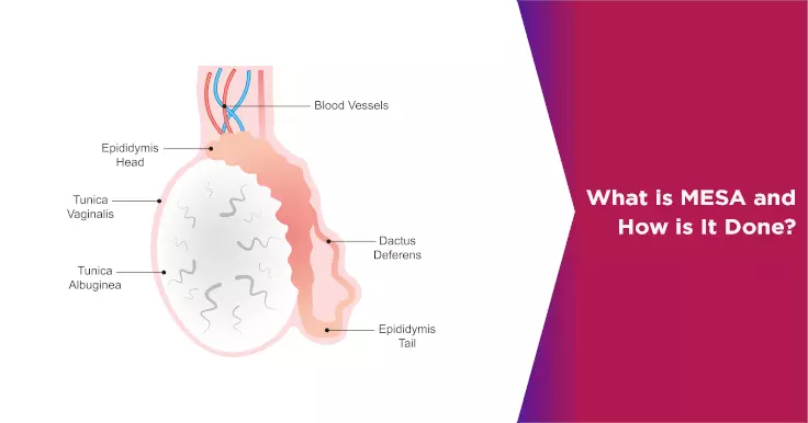  MESA Sperm Retrieval Procedures: What You Need to Know