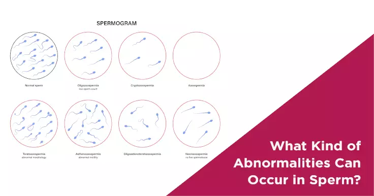  Types of Sperm Abnormalities: Impact on Male Fertility