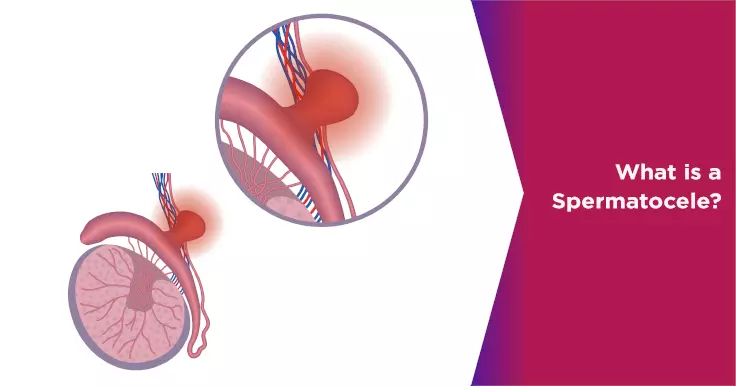 What is Spermatocele (Epididymal Cyst)?