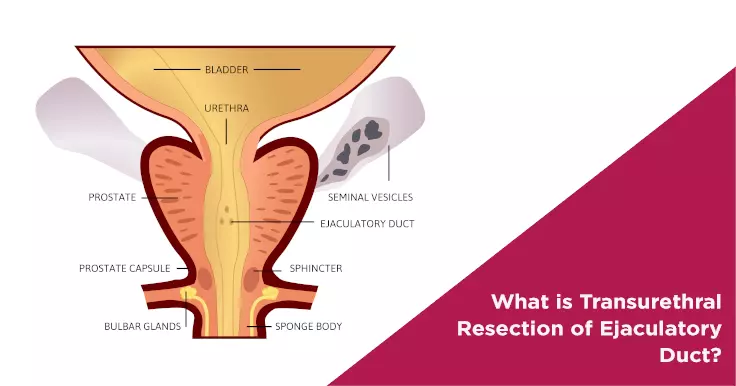  Transurethral Resection of the Ejaculatory Duct Obstructed