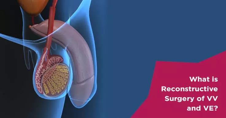  Vasovasostomy and Vasoepididymostomy: Surgical Options for Vasectomy Reversal