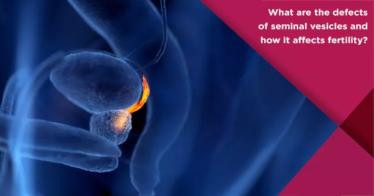  What are Seminal Vesicles And How It Affect Male Fertility?