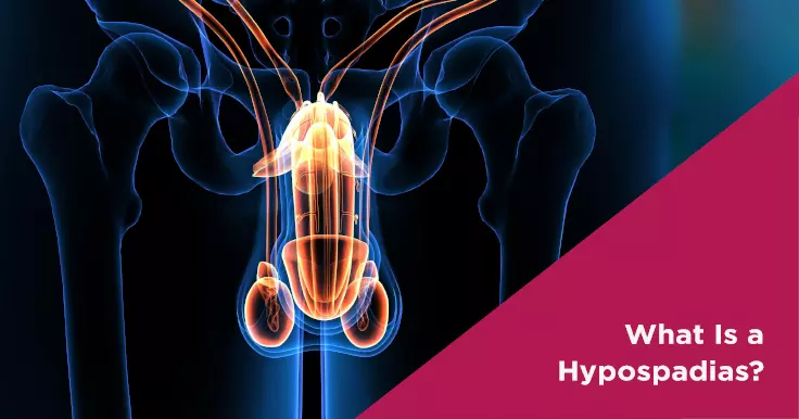 What is Hypospadias and How it is Diagnosed