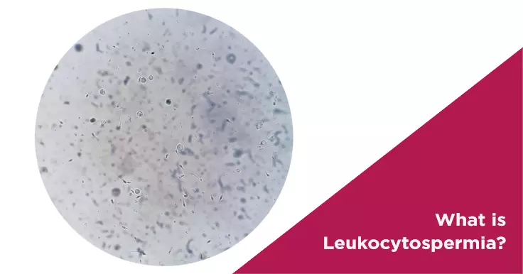  What is Leukocytospermia and Its Impact on Male Fertility?