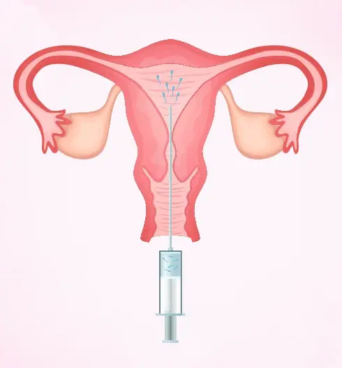 IUI Treatment