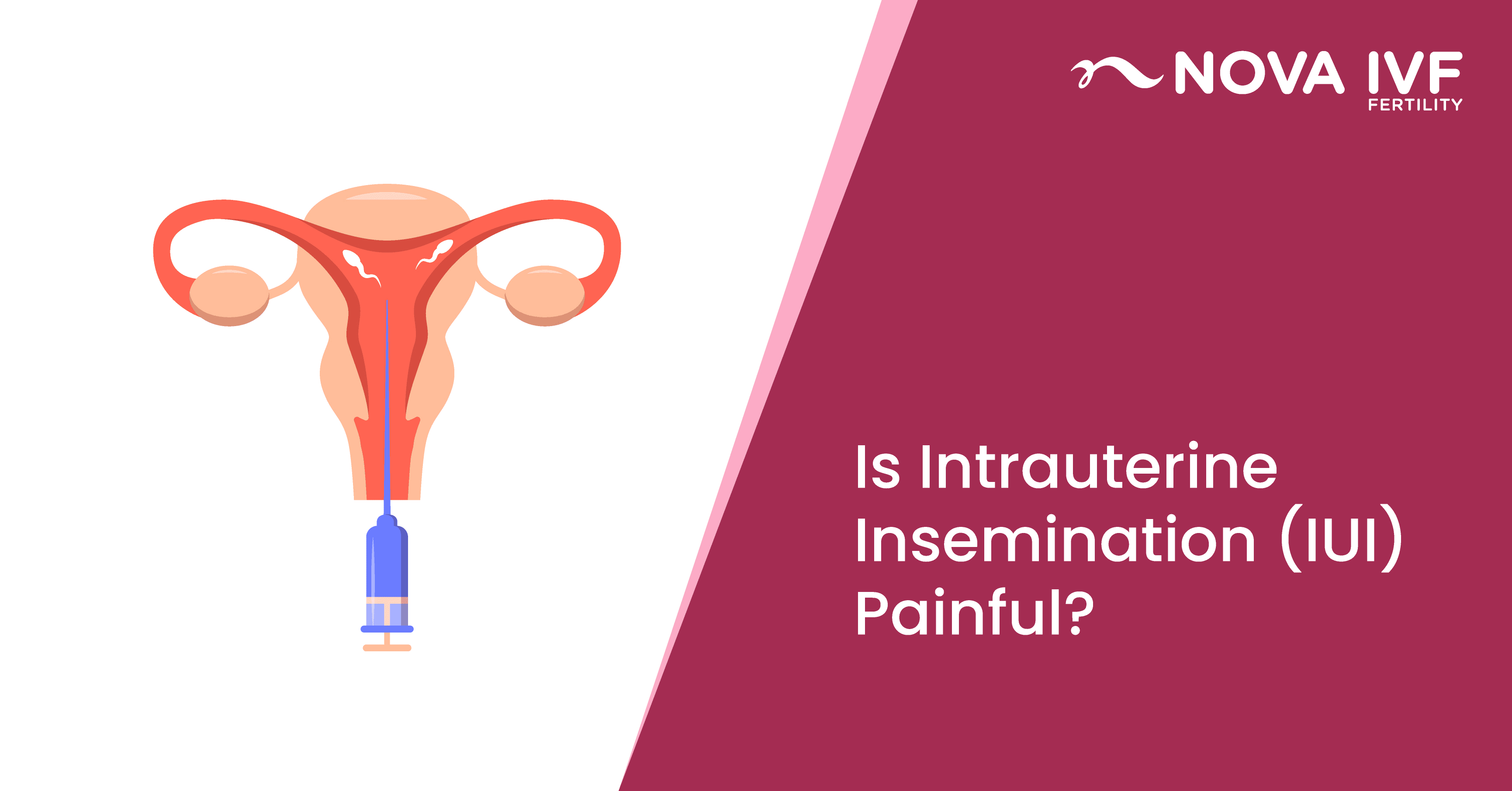 Is Intrauterine Insemination (IUI) Painful? 
