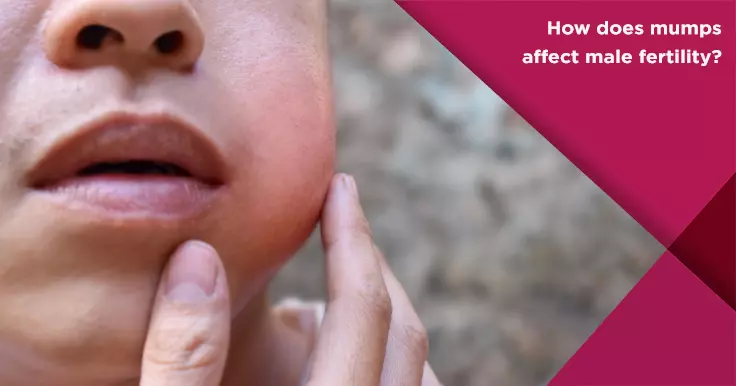 Understanding Mumps and Its Impact on Health