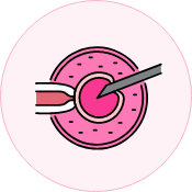 Intracytoplasmic Sperm Injection (ICSI)