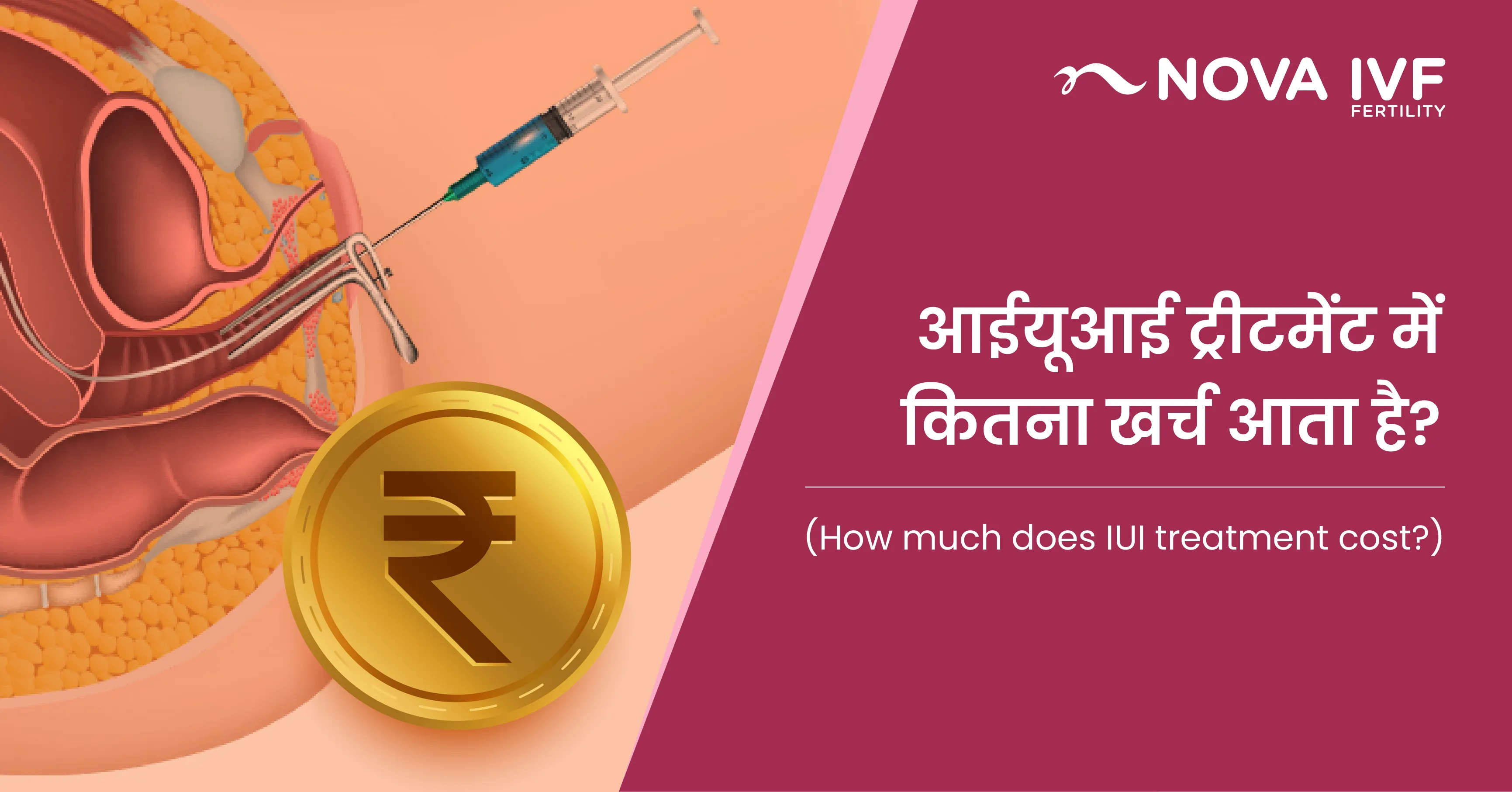 आईयूआई ट्रीटमेंट में कितना खर्च आता है? (How Much Does IUI Treatment Cost in Hindi) 