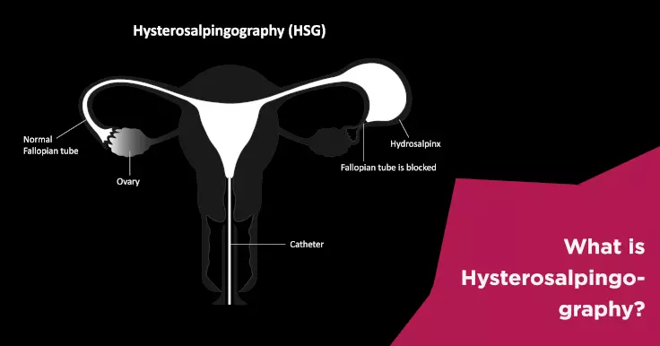 Hysterosalpingography Test