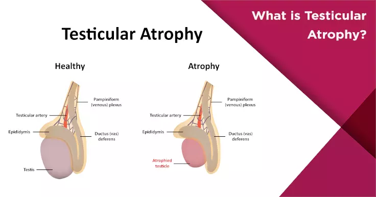 Testicular Atrophy