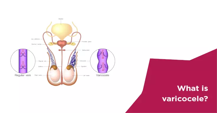 Varicocele